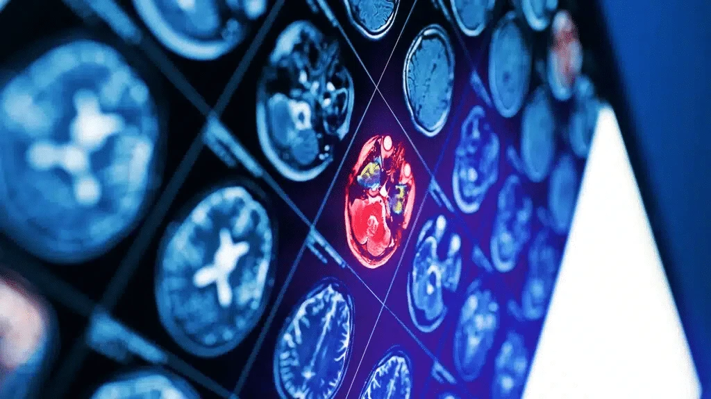 CNS Pharmaceuticals is working on brain cancer therapy / Photo: Shutterstock