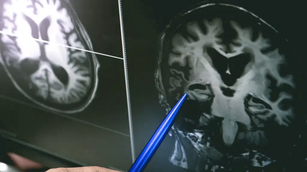 Existing Alzheimer’s therapies target amyloid, a substance that forms plaques in the brain. / Photo: Shutterstock