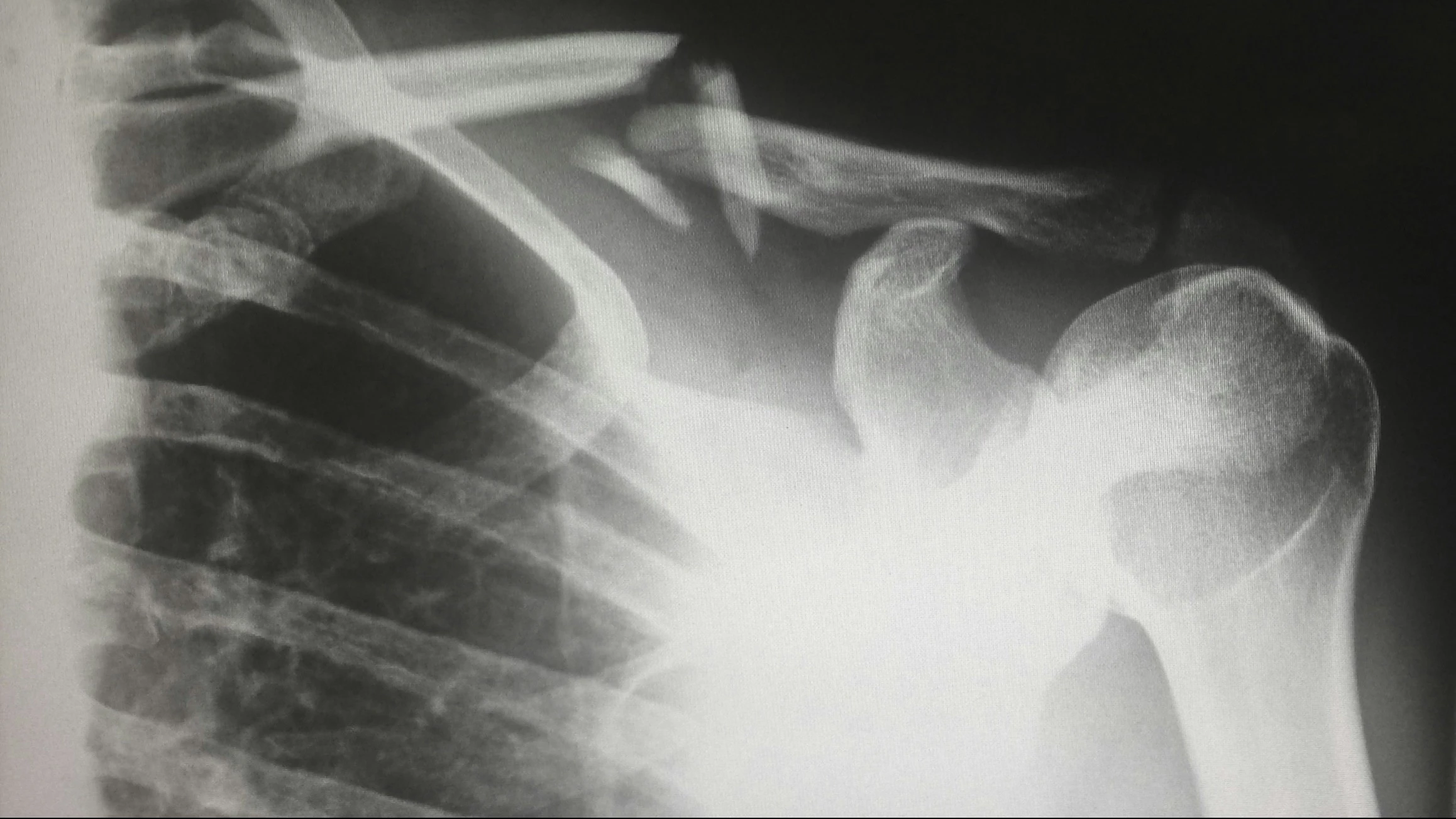 Shoulder Innovations IPO: shares of medtech with AI solutions for surgery become available